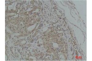 Immunohistochemistry (IHC) analysis of paraffin-embedded Human Breast Carcinoma using TGFbeta1 Polyclonal Antibody. (TGFB1 Antikörper)