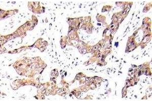 Immunohistochemistry (IHC) analyzes of p-FKHR/FOXO1A antibody in paraffin-embedded human breast carcinoma tissue. (FOXO1 Antikörper  (pSer256))