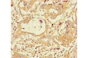 Immunohistochemistry of paraffin-embedded human pancreatic cancer using ABIN7160703 at dilution of 1:100 (PGLYRP2 Antikörper  (AA 22-576))