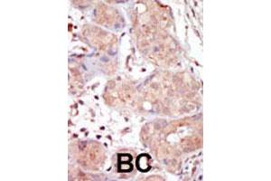 Formalin-fixed and paraffin-embedded human cancer tissue reacted with MAK polyclonal antibody  , which was peroxidase-conjugated to the secondary antibody, followed by DAB staining. (MAK Antikörper  (C-Term))