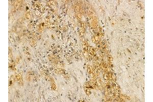 AWAT2 Mouse Monoclonal Antibody at 1/100 staining human kidney cancer by IHC-P. (AWAT2 Antikörper  (Internal Region))