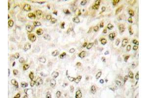 Immunohistochemistry analyzes of Chk1 antibody in paraffin-embedded human breast carcinoma tissue. (CHEK1 Antikörper)