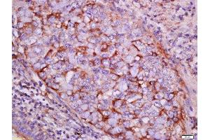 Formalin-fixed and paraffin embedded human lung carcinoma labeled with Rabbit Anti-pan-Cytokeratin Polyclonal Antibody, Unconjugated  at 1:200 followed by conjugation to the secondary antibody and DAB staining