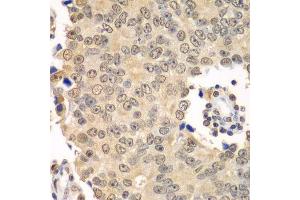Immunohistochemistry of paraffin-embedded human prostate cancer using HDAC2 antibody. (HDAC2 Antikörper  (C-Term))