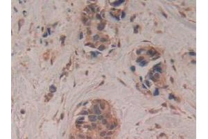 IHC-P analysis of Human Breast Cancer Tissue, with DAB staining. (GAP43 Antikörper  (AA 1-274))