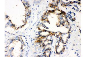Anti- CTGF Picoband antibody, IHC(P) IHC(P): Human Mammary Cancer Tissue (CTGF Antikörper  (AA 58-349))