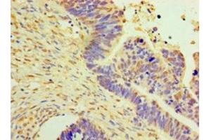 Immunohistochemistry of paraffin-embedded human ovarian cancer using ABIN7150514 at dilution of 1:100 (DNAJB2 Antikörper  (AA 2-324))