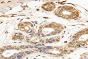 Immunohistochemistry analysis of paraffin-embedded human breast cancer using TPPP3 (ABIN7076047) at dilution of 1: 3000 (TPPP3 Antikörper)