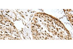 Immunohistochemistry of paraffin-embedded Human esophagus cancer tissue using H2AFJ Polyclonal Antibody at dilution of 1:170(x200) (H2AFJ Antikörper)