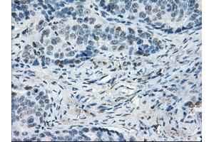 Immunohistochemical staining of paraffin-embedded Adenocarcinoma of colon tissue using anti-LTA4H mouse monoclonal antibody. (LTA4H Antikörper)