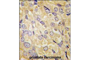 Formalin-fixed and paraffin-embedded human prostate carcinoma tissue reacted with FZD1 polyclonal antibody  , which was peroxidase-conjugated to the secondary antibody, followed by DAB staining. (FZD1 Antikörper  (Internal Region))