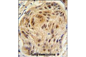 Formalin-fixed and paraffin-embedded human lung carcinoma tissue reacted with LSM1 antibody , which was peroxidase-conjugated to the secondary antibody, followed by DAB staining. (LSM1 Antikörper  (C-Term))