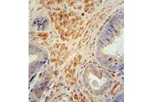 Immunohistochemistry analysis in formalin fixed and paraffin embedded human prostate carcinoma reacted with FSTL1 Antibody (C-term) followed by peroxidase conjugation of the secondary antibody and DAB staining. (FSTL1 Antikörper  (C-Term))