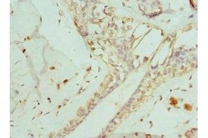 Immunohistochemistry of paraffin-embedded human breast cancer using ABIN7151371 at dilution of 1:100 (ENTPD2 Antikörper  (AA 28-268))