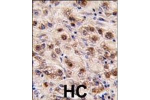 Formalin-fixed and paraffin-embedded human hepatocarcinoma tissue reacted with MINA (C-term) (ABIN387880 and ABIN2844089) , which was peroxidase-conjugated to the secondary antibody, followed by DAB staining.