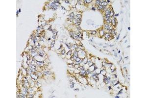 Immunohistochemistry of paraffin-embedded Human gastric cancer using CHN1 Polyclonal Antibody at dilution of 1:100 (40x lens).
