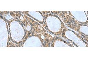 Immunohistochemistry of paraffin-embedded Human thyroid cancer tissue using CNTN4 Polyclonal Antibody at dilution of 1:65(x200) (Contactin 4 Antikörper)