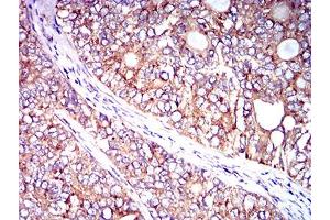 Immunohistochemical analysis of paraffin-embedded cervical cancer tissues using CD102 mouse mAb with DAB staining. (ICAM2 Antikörper  (AA 25-223))