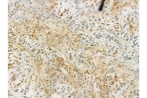 ABIN6263601 and ABIN6276613 at 1/100 staining human gastric carcinoma by IHC-P. (NET1 Antikörper  (C-Term))