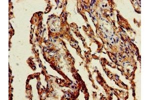 Immunohistochemistry of paraffin-embedded human lung cancer using ABIN7154472 at dilution of 1:100 (GADD45G Antikörper  (AA 1-159))