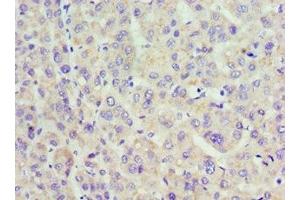 Immunohistochemistry of paraffin-embedded human liver cancer using ABIN7142321 at dilution of 1:100 (ACAA1 Antikörper  (AA 27-300))
