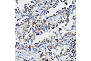 Immunohistochemistry of paraffin-embedded human lung cancer using GSTK1 Rabbit pAb (ABIN1680136, ABIN3019398, ABIN3019399 and ABIN6220875) at dilution of 1:25 (40x lens). (GSTK1 Antikörper  (AA 1-226))