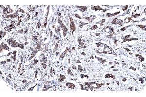 IHC-P Image Immunohistochemical analysis of paraffin-embedded human breast cancer, using MAP2K2, antibody at 1:100 dilution. (MEK2 Antikörper)