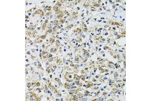 Immunohistochemistry of paraffin-embedded human uterine cancer using TXN2 antibody (ABIN2560616) at dilution of 1:100 (40x lens). (TXN2 Antikörper)
