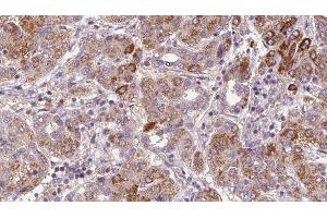 ABIN6272365 at 1/100 staining Human liver cancer tissue by IHC-P. (NMUR1 Antikörper  (N-Term))