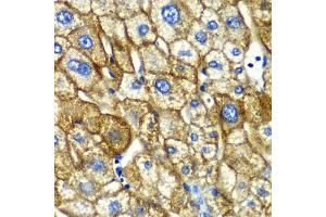Immunohistochemistry of paraffin-embedded human liver injury using ASGR1 antibody (ABIN5975060) at dilution of 1/100 (40x lens). (Asialoglycoprotein Receptor 1 Antikörper)
