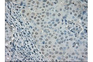 Immunohistochemical staining of paraffin-embedded Adenocarcinoma of ovary tissue using anti-DHFRmouse monoclonal antibody. (Dihydrofolate Reductase Antikörper)