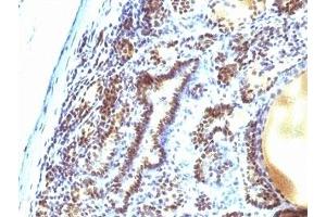 Formalin-fixed, paraffin-embedded human thyroid carcinoma stained with MAP3K1 antibody (2F6). (MAP3K1 Antikörper  (AA 1211-1310))