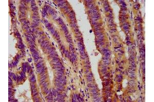 IHC image of ABIN7152698 diluted at 1:800 and staining in paraffin-embedded human colon cancer performed on a Leica BondTM system. (FERMT1 Antikörper  (AA 321-420))