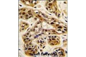 Formalin-fixed and paraffin-embedded human breast carcinoma tissue reacted with PRMT1 antibody (C-term ), which was peroxidase-conjugated to the secondary antibody, followed by DAB staining.