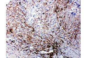 Anti-LTBR antibody, IHC(P) IHC(P): Human Intestinal Cancer Tissue