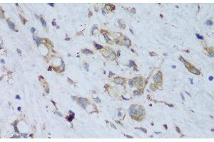 Immunohistochemistry of paraffin-embedded Human gastric cancer using ENPP3 Polyclonal Antibody at dilution of 1:150 (40x lens). (ENPP3 Antikörper)