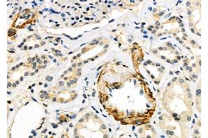 ABIN6259876 and ABIN6279101 at 1/100 staining Human kidney cancer and adjacent normal tissues by IHC-P. (ALDH1A3 Antikörper  (Internal Region))