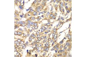 Immunohistochemistry of paraffin-embedded human esophageal cancer using VTI1B antibody (ABIN5974248) at dilution of 1/100 (40x lens).