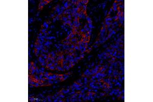 Immunofluorescence of paraffin embedded human lung cancer using MRP1 (ABIN7074544) at dilution of 1:1000 (250x lens) (MRP1 Antikörper)