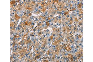 Immunohistochemistry of Human liver cancer using BCL10 Polyclonal Antibody at dilution of 1:40 (BCL10 Antikörper)