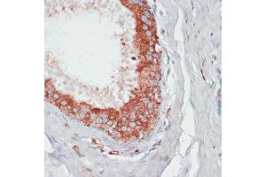 Immunohistochemistry of paraffin-embedded human mammary cancer using PGK2 antibody (ABIN6128431, ABIN6145506, ABIN6145507 and ABIN6216775) at dilution of 1:100 (40x lens). (PGK2 Antikörper  (AA 242-360))