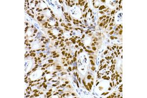 Immunohistochemistry of paraffin-embedded human colon carcinoma using DNA-PKcs Rabbit mAb (ABIN7269665) at dilution of 1:100 (40x lens). (PRKDC Antikörper)