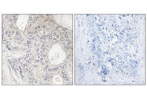 Immunohistochemistry analysis of paraffin-embedded human breast carcinoma tissue, using Cytochrome P450 1A2 antibody. (CYP1A2 Antikörper  (Internal Region))