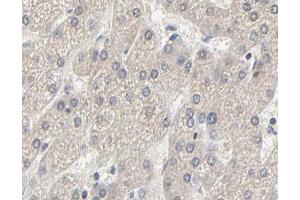 ABIN6267630 at 1/200 staining human liver cancer tissue sections by IHC-P. (Acetyl-CoA Carboxylase alpha Antikörper  (pSer79))