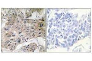 Immunohistochemistry analysis of paraffin-embedded human breast carcinoma tissue using COX7S/A2 antibody.