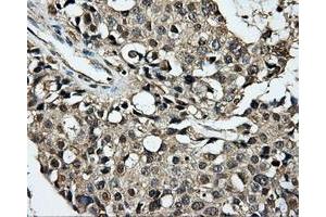 Immunohistochemical staining of paraffin-embedded Adenocarcinoma of breast tissue using anti-PLEK mouse monoclonal antibody. (Pleckstrin Antikörper)