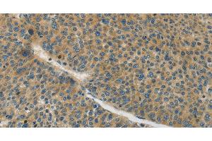 Immunohistochemistry of paraffin-embedded Human liver cancer tissue using Connexin-45 Polyclonal Antibody at dilution 1:50 (GJC1 Antikörper)