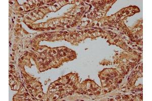 IHC image of ABIN7148511 diluted at 1:100 and staining in paraffin-embedded human prostate cancer performed on a Leica BondTM system. (CPNE1 Antikörper  (AA 326-537))