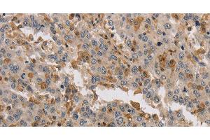 Immunohistochemistry of paraffin-embedded Human liver cancer tissue using KIF17 Polyclonal Antibody at dilution 1:40 (KIF17 Antikörper)