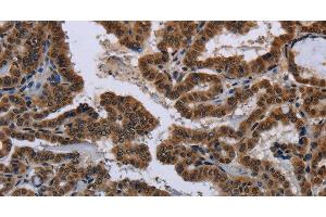 Immunohistochemistry of paraffin-embedded Human gastric cancer tissue using MYCN Polyclonal Antibody at dilution 1:35 (MYCN Antikörper)